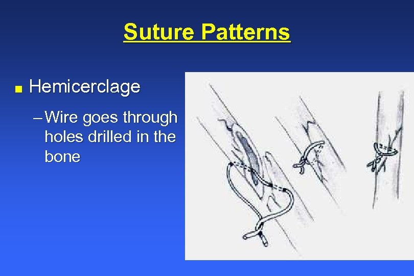 Suture Patterns n Hemicerclage – Wire goes through holes drilled in the bone 