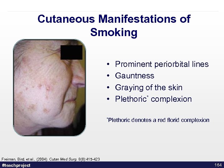 Cutaneous Manifestations of Smoking • • Prominent periorbital lines Gauntness Graying of the skin