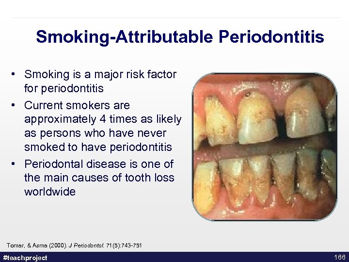 Smoking-Attributable Periodontitis • Smoking is a major risk factor for periodontitis • Current smokers