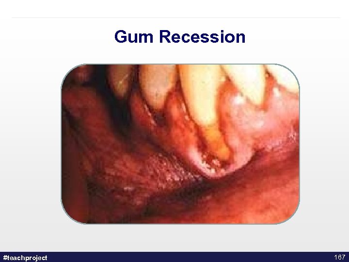 Gum Recession #teachproject 167 