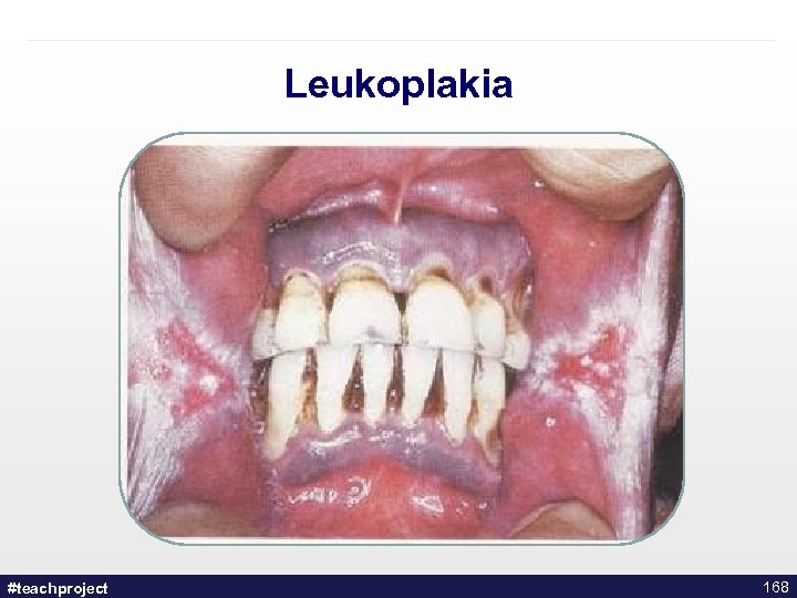 Leukoplakia #teachproject 168 