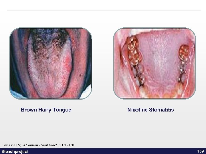 Brown Hairy Tongue Nicotine Stomatitis Davis (2005). J Contemp Dent Pract. , 6: 158