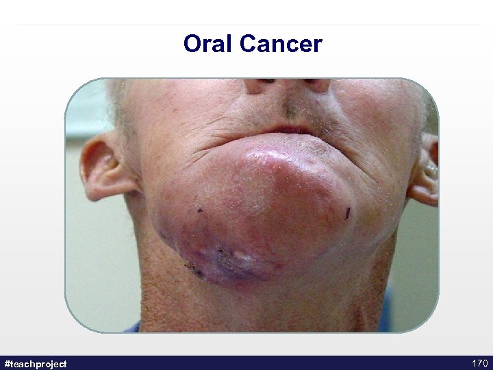 Oral Cancer #teachproject 170 