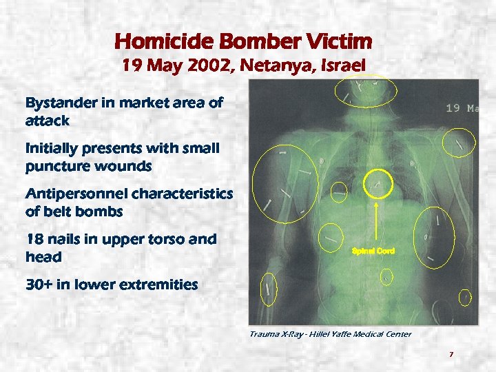 Homicide Bomber Victim 19 May 2002, Netanya, Israel Bystander in market area of attack