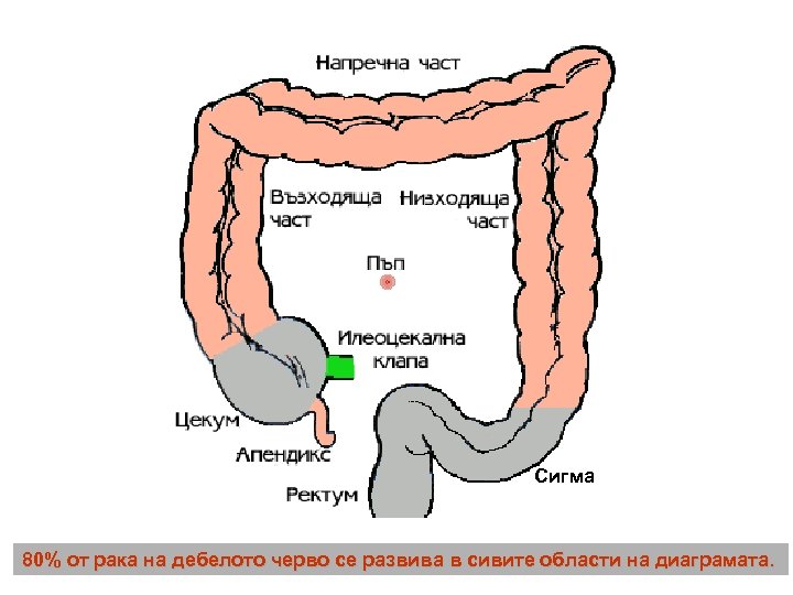 Сигма 80% от рака на дебелото черво се развива в сивите области на диаграмата.
