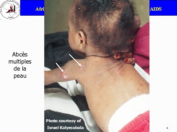 ANECCA African Network for the Care of Children Affected by AIDS Abcès multiples de