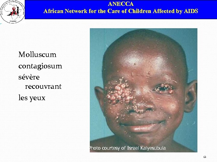 ANECCA African Network for the Care of Children Affected by AIDS Molluscum contagiosum sévère