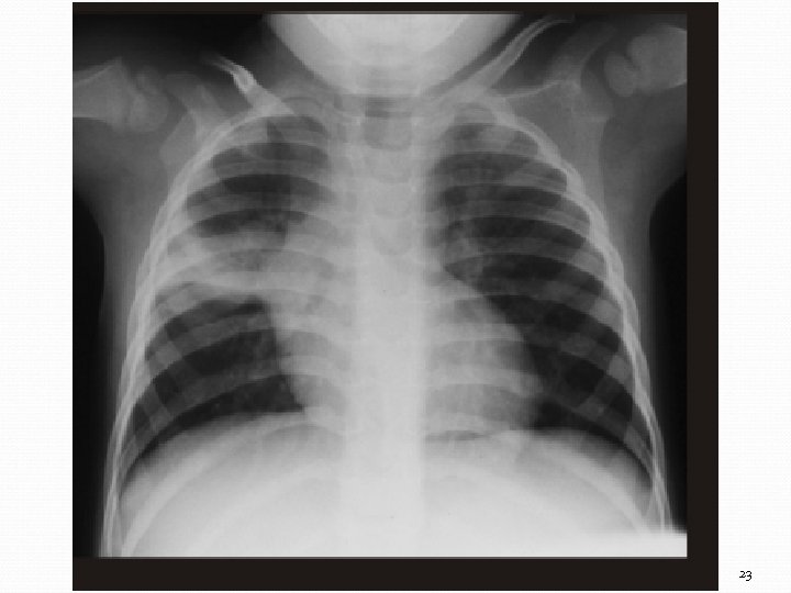 Complexe primaire avec une consolidation- atéletasie ségmentaire au sommet du lobe supérieur droit 23
