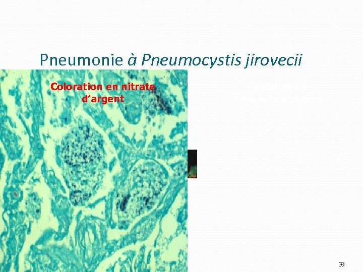 Pneumonie à Pneumocystis jirovecii Coloration en nitrate d’argent Coloration en Immunofluorescence 33 