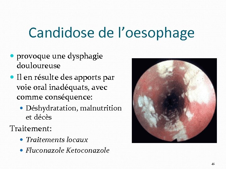 Candidose de l’oesophage provoque une dysphagie douloureuse Il en résulte des apports par voie