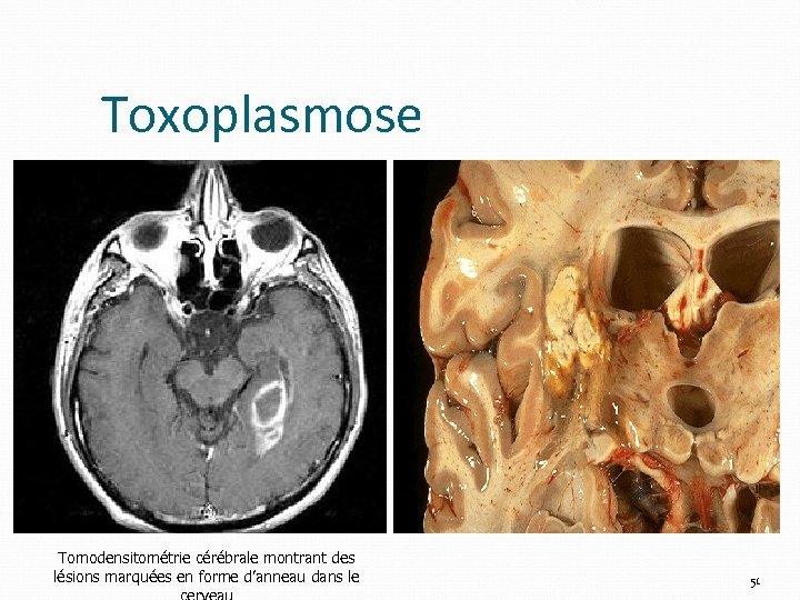 Toxoplasmose Tomodensitométrie cérébrale montrant des lésions marquées en forme d’anneau dans le 51 