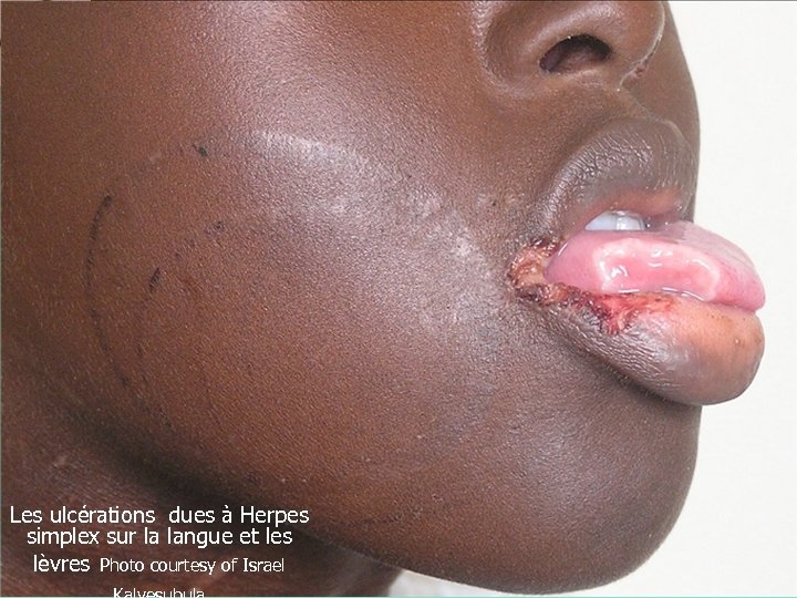 ANECCA African Network for the Care of Children Affected by AIDS Les ulcérations dues