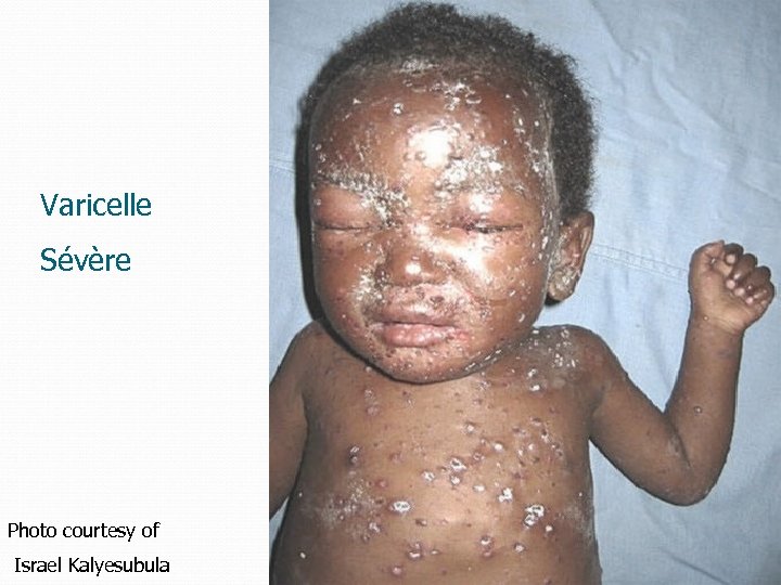 Varicelle Sévère Photo courtesy of Israel Kalyesubula 60 