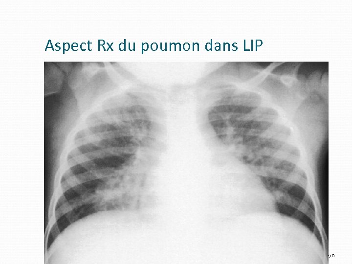 Aspect Rx du poumon dans LIP 70 
