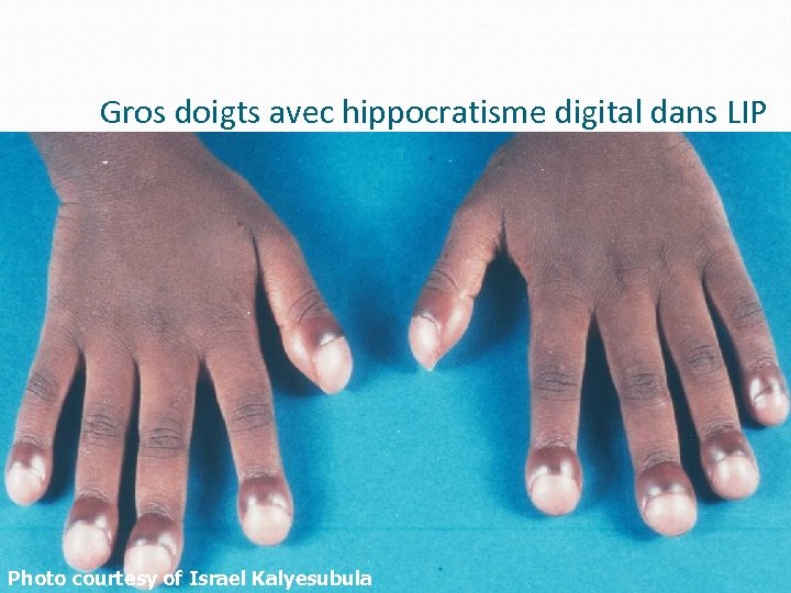 Gros doigts avec hippocratisme digital dans LIP Photo courtesy of Israel Kalyesubula 71 