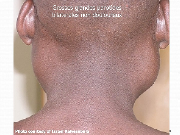 Grosses glandes parotides bilaterales non douloureux Photo courtesy of Israel Kalyesubula 72 