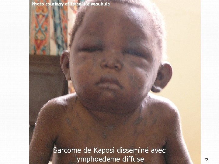 Photo courtesy of Israel Kalyesubula Sarcome de Kaposi disseminé avec lymphoedeme diffuse 75 