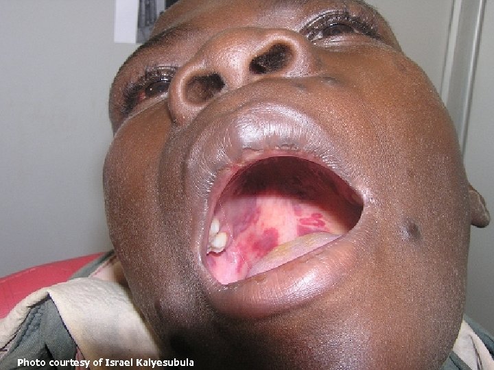 ANECCA African Network for the Care of Children Affected by AIDS Lesions sarcomateuses de