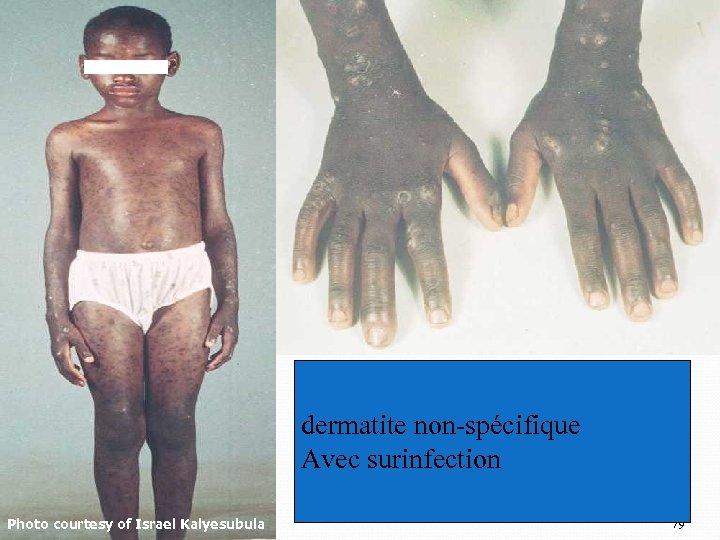 dermatite non-spécifique Avec surinfection Photo courtesy of Israel Kalyesubula 79 