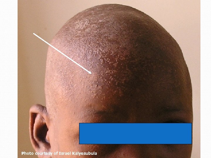 Lesions de verrues planesverruca plana Lesions of Photo courtesy of Israel Kalyesubula 80 