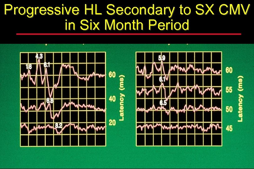 Progressive HL Secondary to SX CMV in Six Month Period 