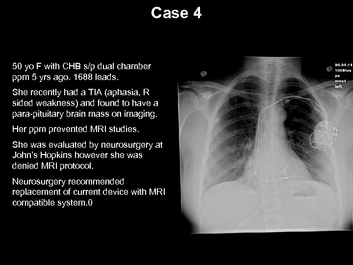 Case 4 50 yo F with CHB s/p dual chamber ppm 5 yrs ago.