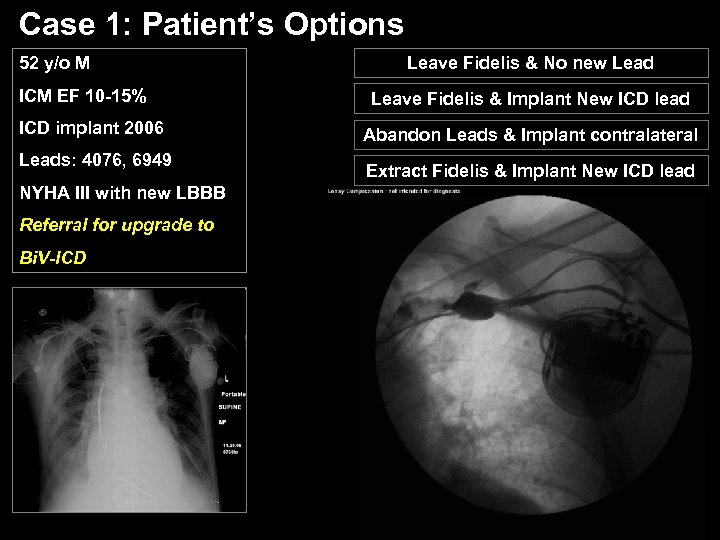 Case 1: Patient’s Options 52 y/o M ICM EF 10 -15% ICD implant 2006