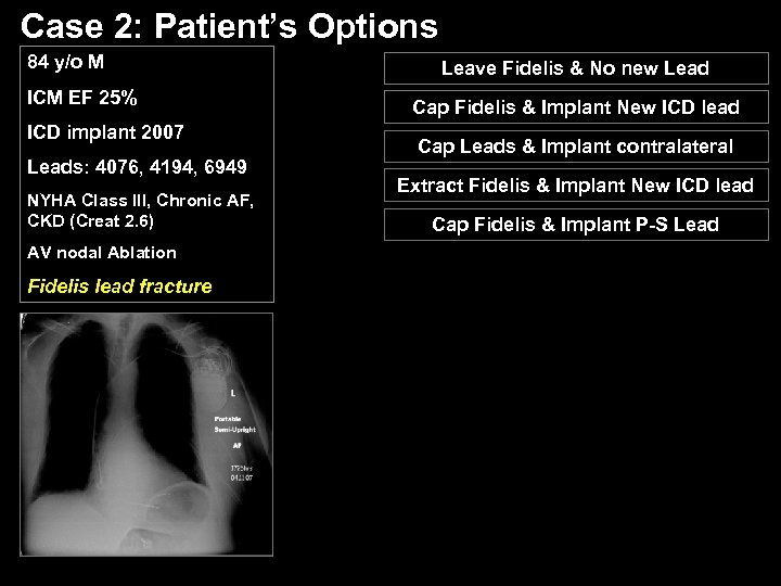 Case 2: Patient’s Options 84 y/o M ICM EF 25% ICD implant 2007 Leads: