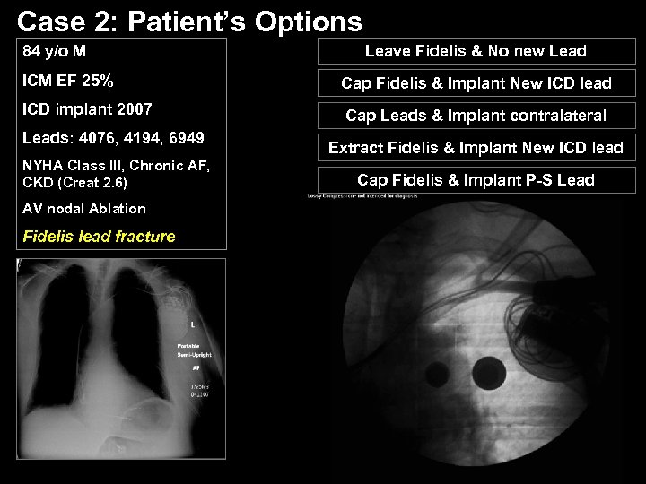 Case 2: Patient’s Options 84 y/o M ICM EF 25% ICD implant 2007 Leads: