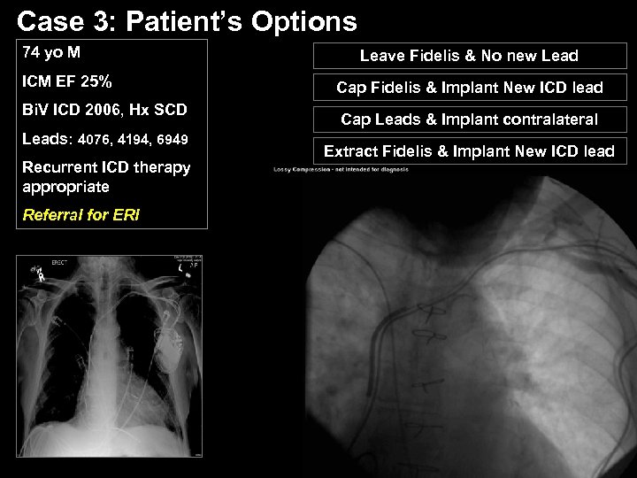 Case 3: Patient’s Options 74 yo M ICM EF 25% Bi. V ICD 2006,