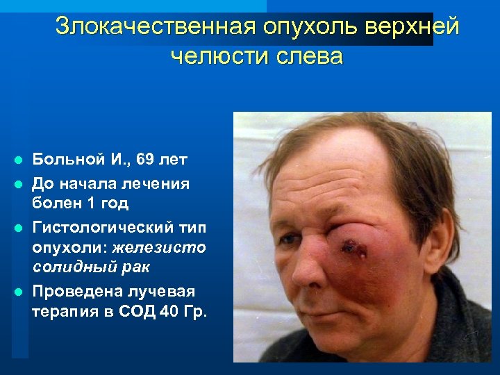 Злокачественная опухоль верхней челюсти слева Больной И. , 69 лет l До начала лечения