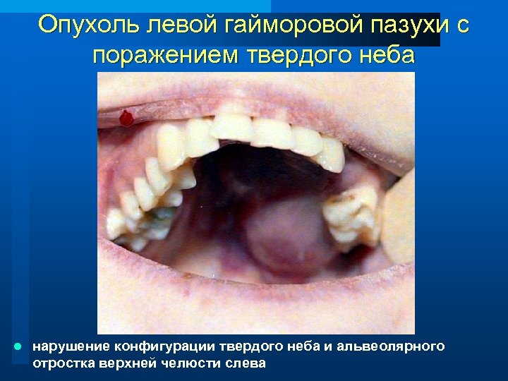 Опухоль левой гайморовой пазухи с поражением твердого неба l нарушение конфигурации твердого неба и