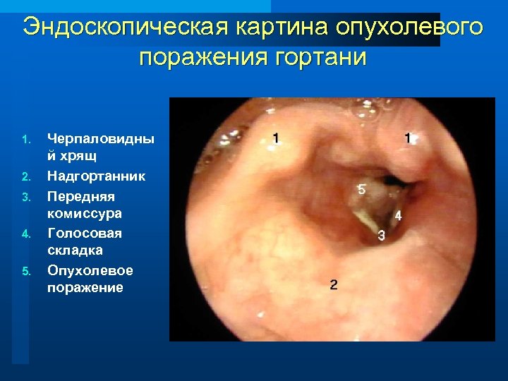 Эндоскопическая картина опухолевого поражения гортани 1. 2. 3. 4. 5. Черпаловидны й хрящ Надгортанник