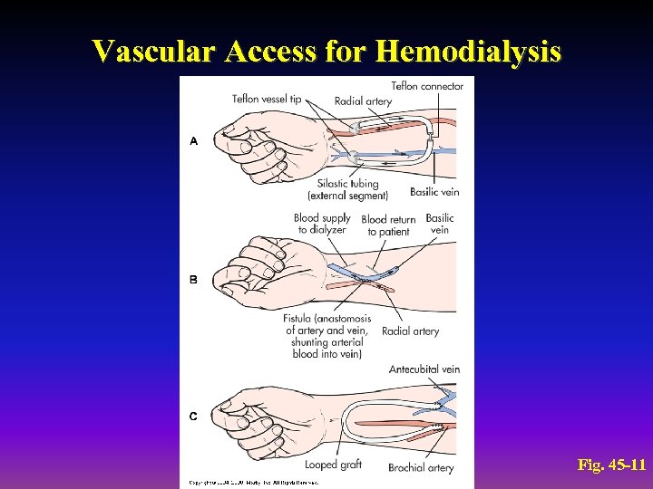 Vascular Access for Hemodialysis Fig. 45 -11 