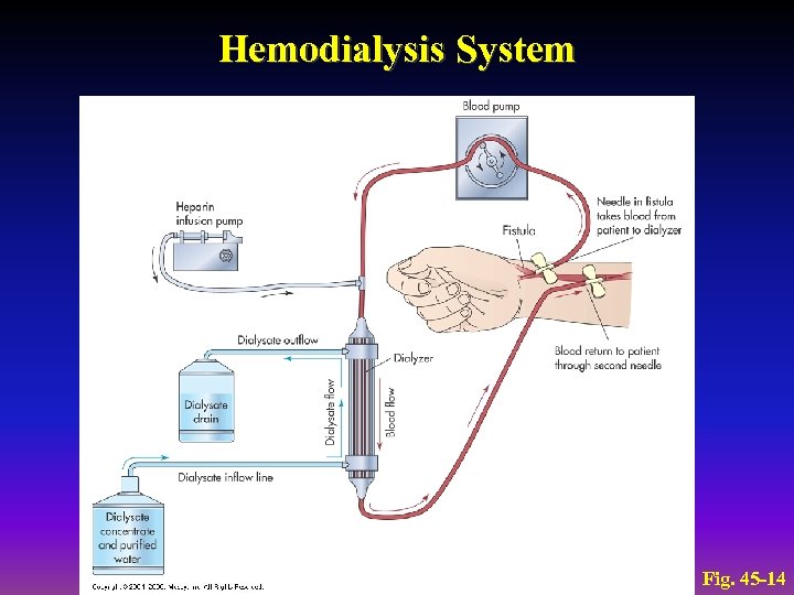 Hemodialysis System Fig. 45 -14 