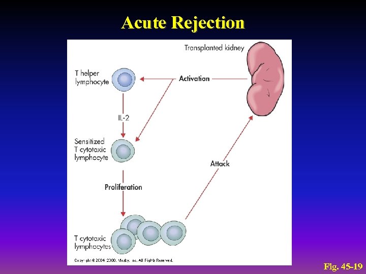 Acute Rejection Fig. 45 -19 