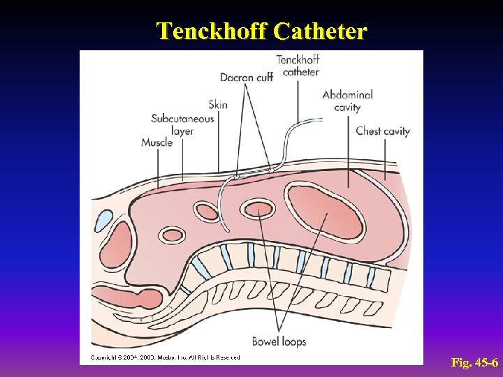 Tenckhoff Catheter Fig. 45 -6 