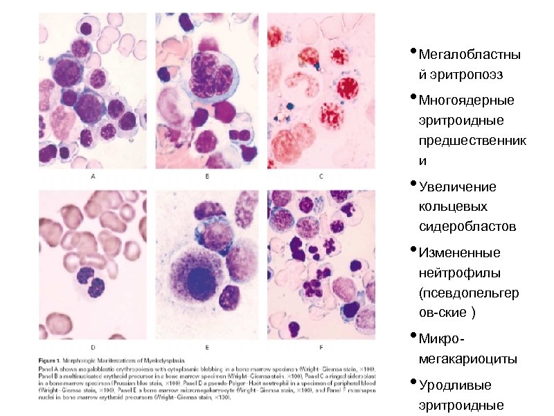  • Мегалобластны й эритропоэз • Многоядерные эритроидные предшественник и • Увеличение кольцевых сидеробластов