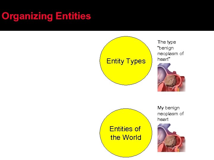 Organizing Entities Entity Types The type “benign neoplasm of heart” My benign neoplasm of