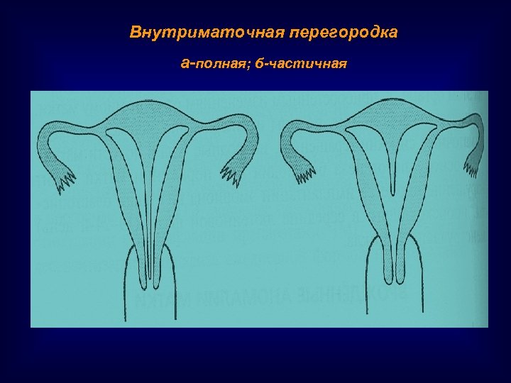 Внутриматочная перегородка а-полная; б-частичная 