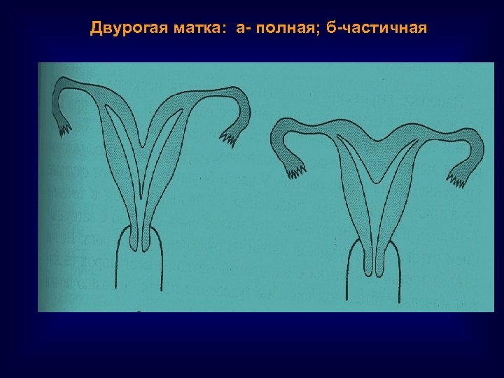 Двурогая матка: а- полная; б-частичная 