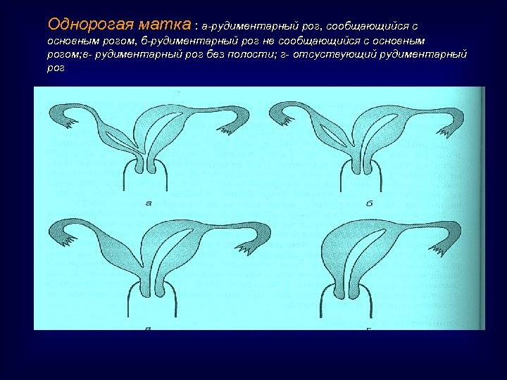 Однорогая матка : а-рудиментарный рог, сообщающийся с основным рогом, б-рудиментарный рог не сообщающийся с