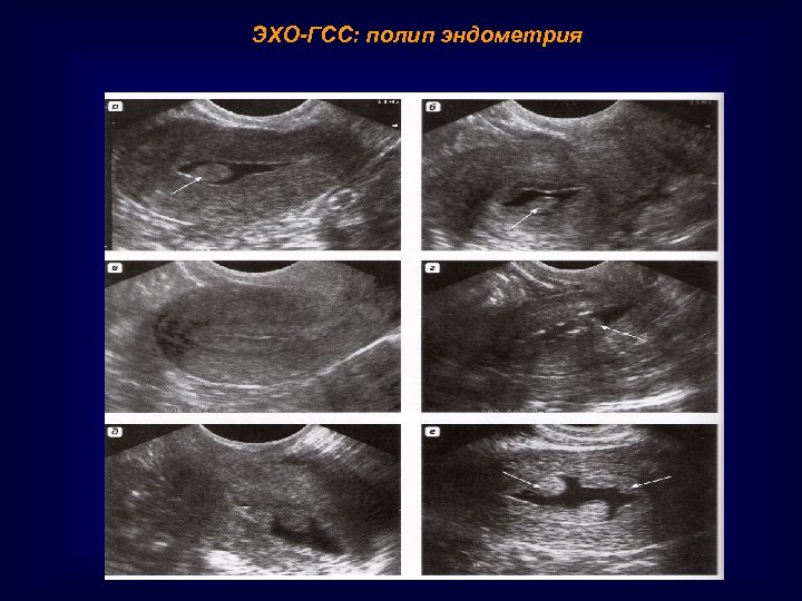 ЭХО-ГСС: полип эндометрия 