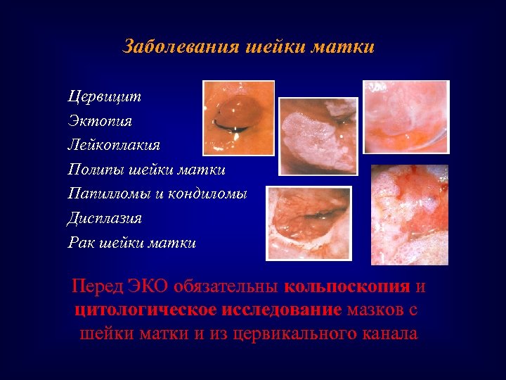 Заболевания шейки матки Цервицит Эктопия Лейкоплакия Полипы шейки матки Папилломы и кондиломы Дисплазия Рак