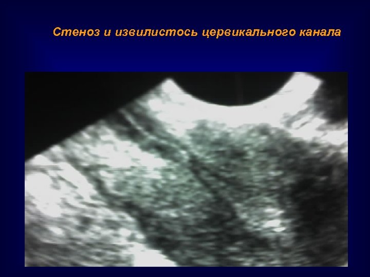 Стеноз и извилистось цервикального канала 