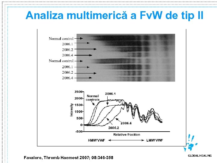 Analiza multimerică a Fv. W de tip II Favaloro, Thromb Haemost 2007; 98: 346