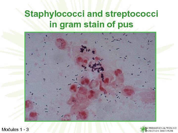 Staphylococci and streptococci in gram stain of pus Modules 1 - 3 