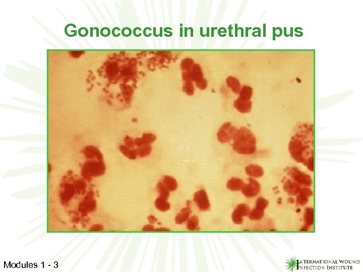 Gonococcus in urethral pus Modules 1 - 3 