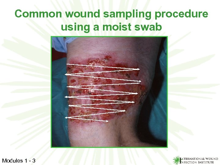 Common wound sampling procedure using a moist swab Modules 1 - 3 