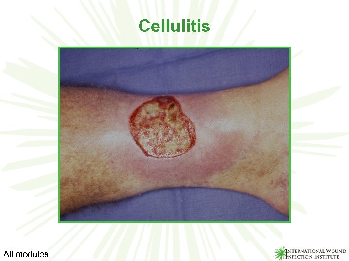 Cellulitis All modules 